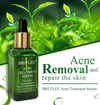 Acne Treatment Serum