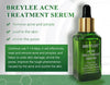 Acne Treatment Serum