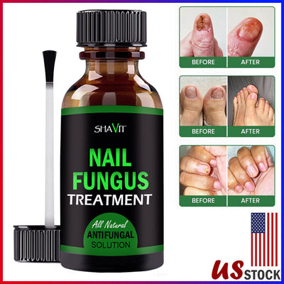 ANTI FUNGAL TREATMENT EXTRA STRENGTH TOENAIL